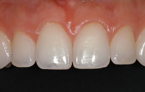 PG-BondingFilling-10a