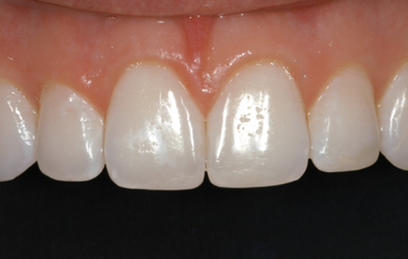 PG-BondingFilling-10b