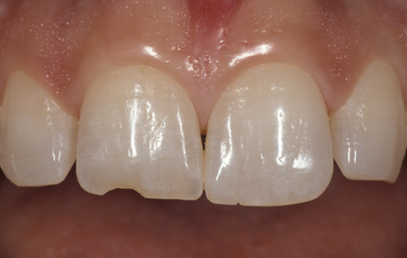PG-BondingFilling-1a