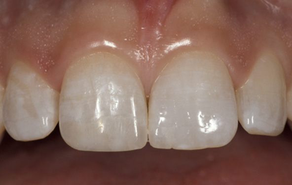 PG-BondingFilling-1b