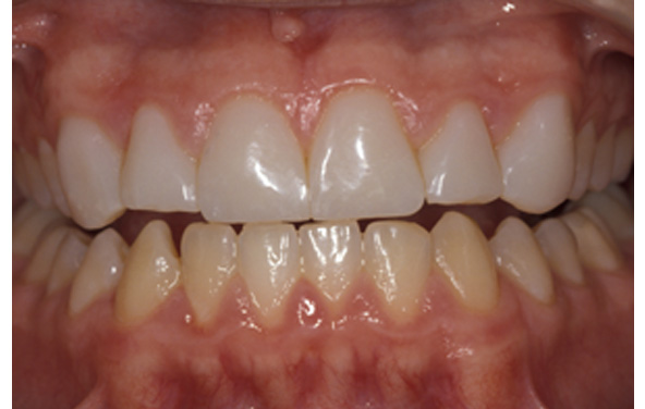 PG-BondingFilling-2ab