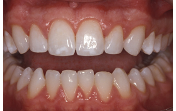 PG-BondingFilling-2bb