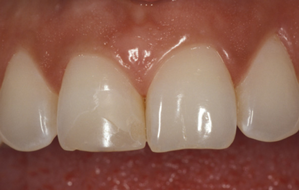 PG-BondingFilling-3a