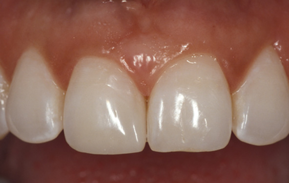 PG-BondingFilling-3b