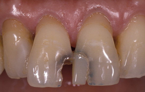 PG-BondingFilling-4a