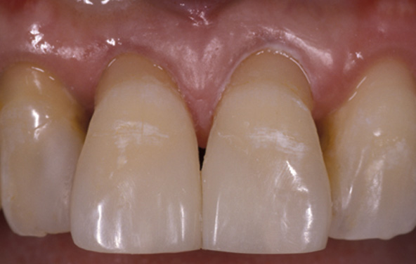 PG-BondingFilling-4b