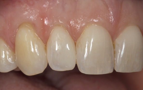PG-BondingFilling-5b