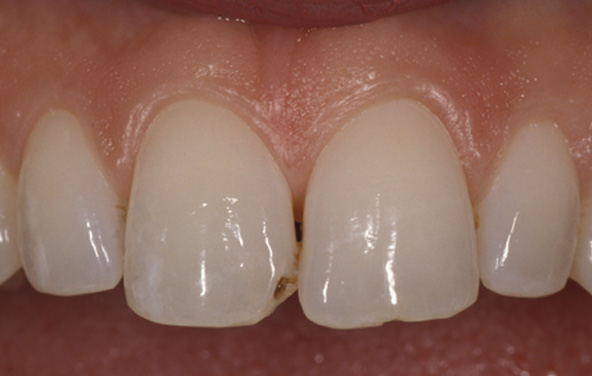 PG-BondingFilling-6a