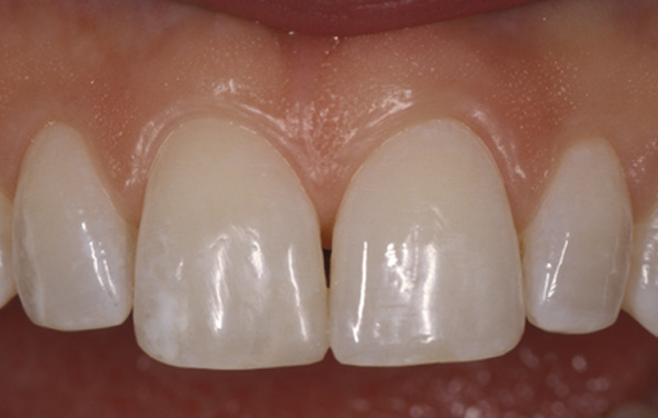 PG-BondingFilling-6b