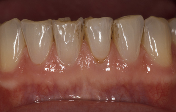 PG-BondingFilling-7a