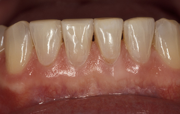 PG-BondingFilling-7b