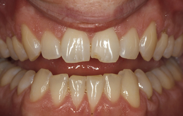 PG-BondingFilling-8a