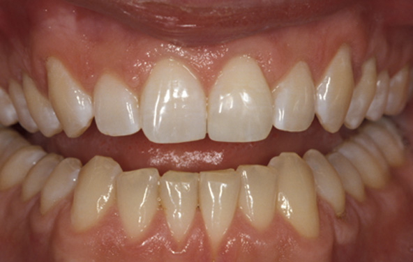 PG-BondingFilling-8b