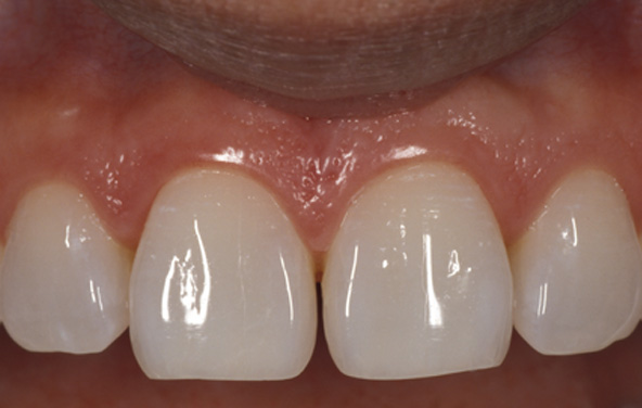 PG-BondingFilling-9a