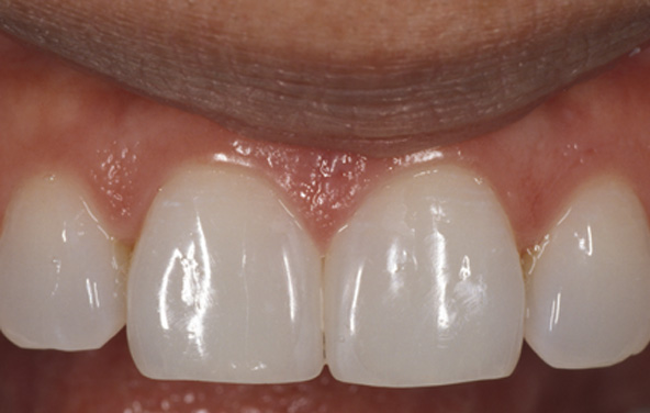 PG-BondingFilling-9b