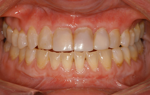 PG-Crowns-13a