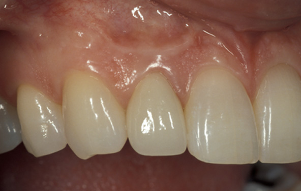 PG-Crowns-14b