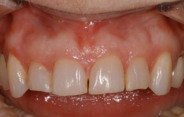 PG-Crowns-3a