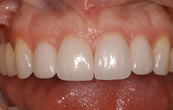 PG-Crowns-3b