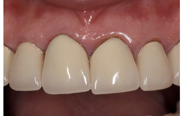 PG-Crowns-4aa