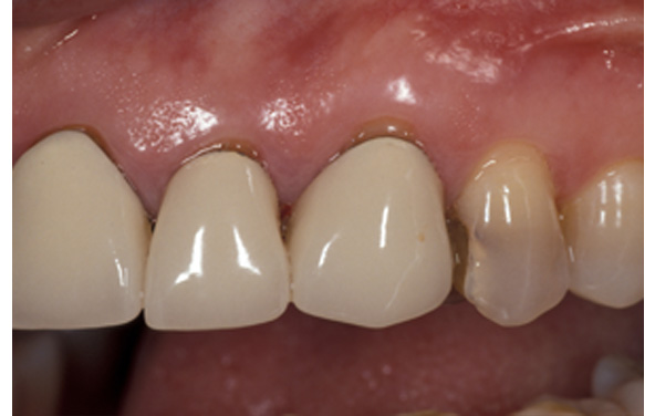 PG-Crowns-4ab