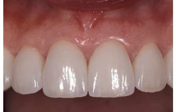 PG-Crowns-4ba