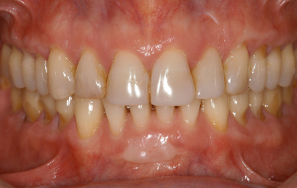 PG-Crowns-9a