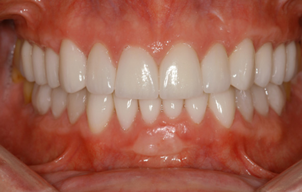 PG-Crowns-9b