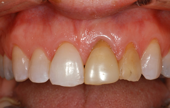PG-GumTreatment-1a
