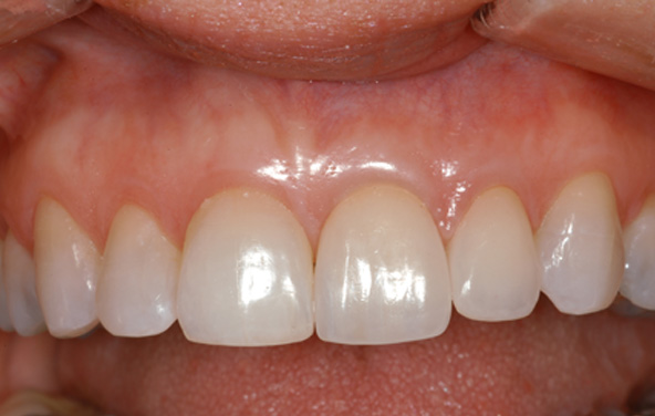 PG-GumTreatment-1b