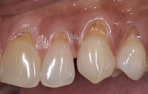 PG-GumTreatment-4a