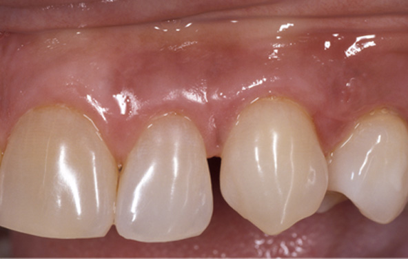 PG-GumTreatment-4b