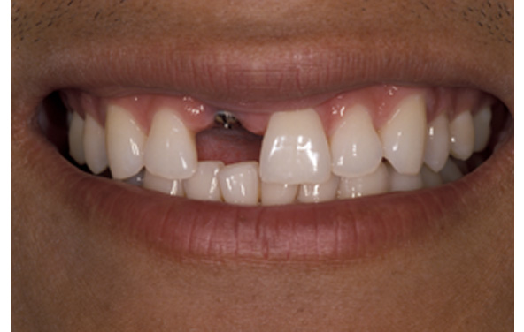 PG-ImplantCrowns-10a