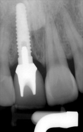 PG-ImplantCrowns-10b