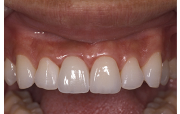 PG-ImplantCrowns-10c
