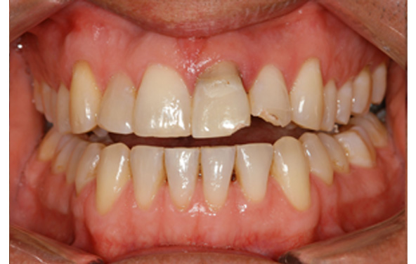 PG-ImplantCrowns-11a