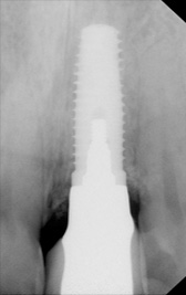 PG-ImplantCrowns-11b