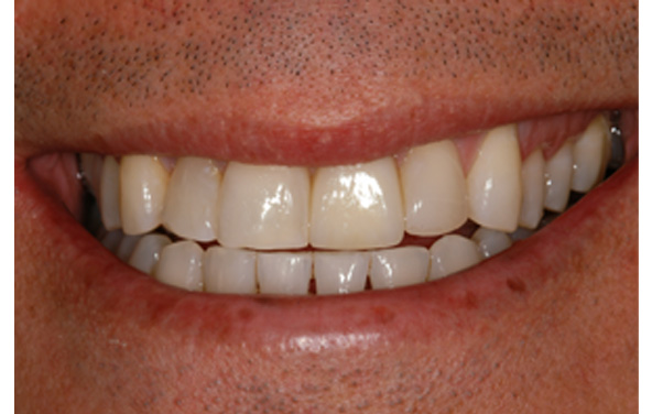 PG-ImplantCrowns-11c