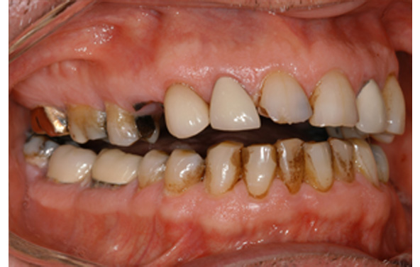 PG-ImplantCrowns-12a