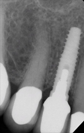 PG-ImplantCrowns-12b