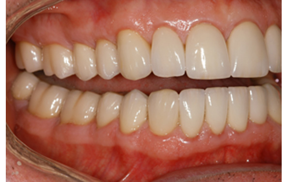PG-ImplantCrowns-12c