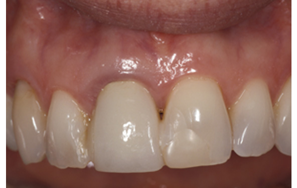 PG-ImplantCrowns-1a