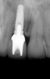 PG-ImplantCrowns-1b