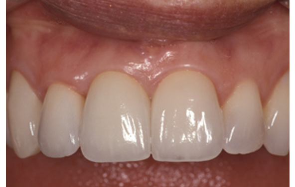 PG-ImplantCrowns-1c