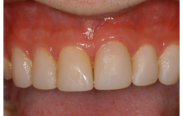 PG-ImplantCrowns-3a