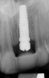 PG-ImplantCrowns-3b