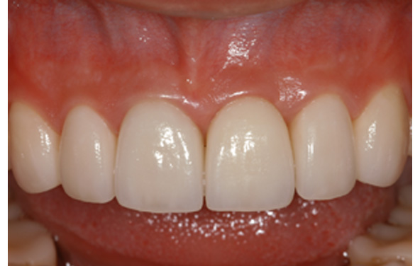 PG-ImplantCrowns-3c