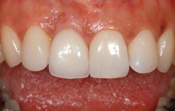 PG-ImplantCrowns-4b