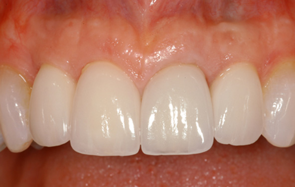 PG-ImplantCrowns-5b