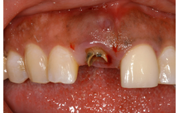 PG-ImplantCrowns-6a